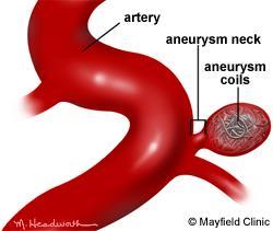 gebloed heeft Bij 5% van de populatie aneurysmata aanwezig (niet geruptureerd)