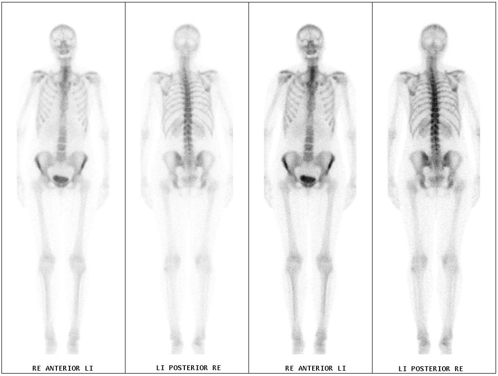 Botscintigrafie SPECT/CT Whole Body