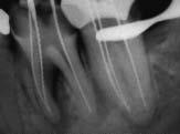 sprake is van pijn, zwelling of een fistel; als het gebitselement normaal functioneert en er op de röntgenfoto sprake is van een normaal doorlopende parodontaallijn rond de wortels van het behandelde