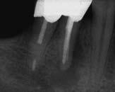 Endodontic Society, 1994). Het grootste deel van de endodontisch behandelde gebitselementen zal na evaluatie echter positief worden beoordeeld.