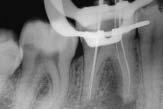 een al eerder uitgevoerde endodontische herbehandeling; de ervaring van de behandelaar; de wens van de patiënt (afb. 3); de kosten van de behandeling.