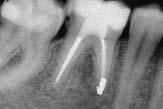 Het uitvoeren van een chirurgische behandeling op een gebitselement met een endodontische behandeling van matige kwaliteit heeft eveneens een lager succespercentage dan een chirurgische behandeling