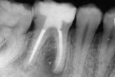 Het kiezen voor herbehandeling of chirurgie hangt dus voor een groot deel af van de kwaliteit van de endodontische behandeling die uitgevoerd is in het gebitselement dat niet genezen is.