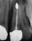 Het wortelkanaal blijkt onvoldoende te zijn gereinigd en afgesloten, waardoor ook apicale chirurgie niet succesvol is gebleken. Er wordt besloten tot endodontische herbehandeling. b. Het gebitselement 21 wordt opnieuw gereinigd en afgesloten tot aan de periapicale afsluiting.