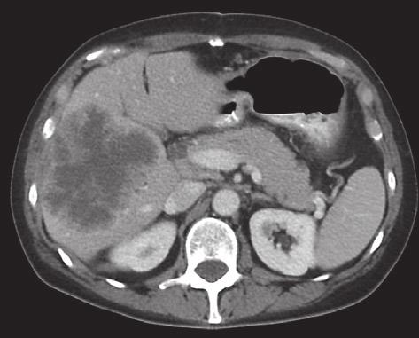 metastase pancreas maag milt a c ventrikel ventrikel long b long metastase d figuur 2.