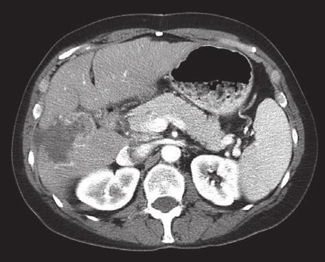 Een aanvullende 4-fasen-CT-scan van de toonde multipele metastasen verspreid in de kwab, waarvan de grootste een diameter van 12 cm had (figuur 2a).