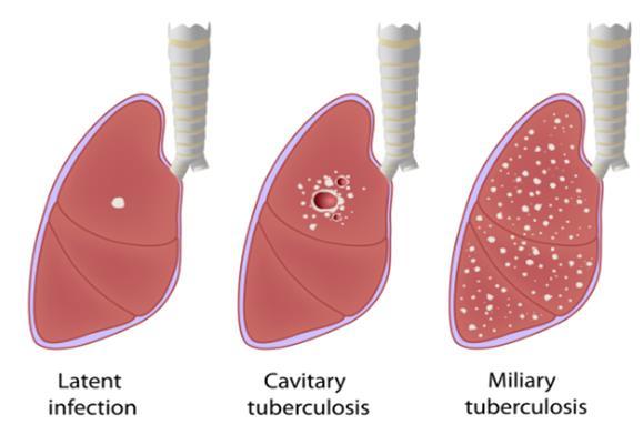 Bij niet of niet goed behandelen kan de ziekte dodelijk zijn. Bij besmetting met tuberculosebacteriën komt de bacterie binnen via de longen.