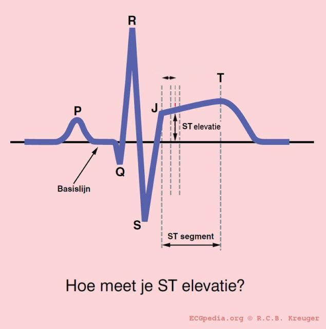 Diagnose infarct Diagnostische criteria voor myocardinfarct: -Hartenzymen verhoogd & -1 van de volgende: -Typische klachten van drukkende snoerende pijn op de borst, eventueel met uistraling naar de