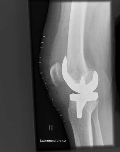 Resultaten totale knieprothese Vóór de operatie en 3, 6 en 12 maanden na het plaatsen van de totale knieprothese, worden vragen gesteld over pijn, het functioneren van de knie en hoe bewust iemand