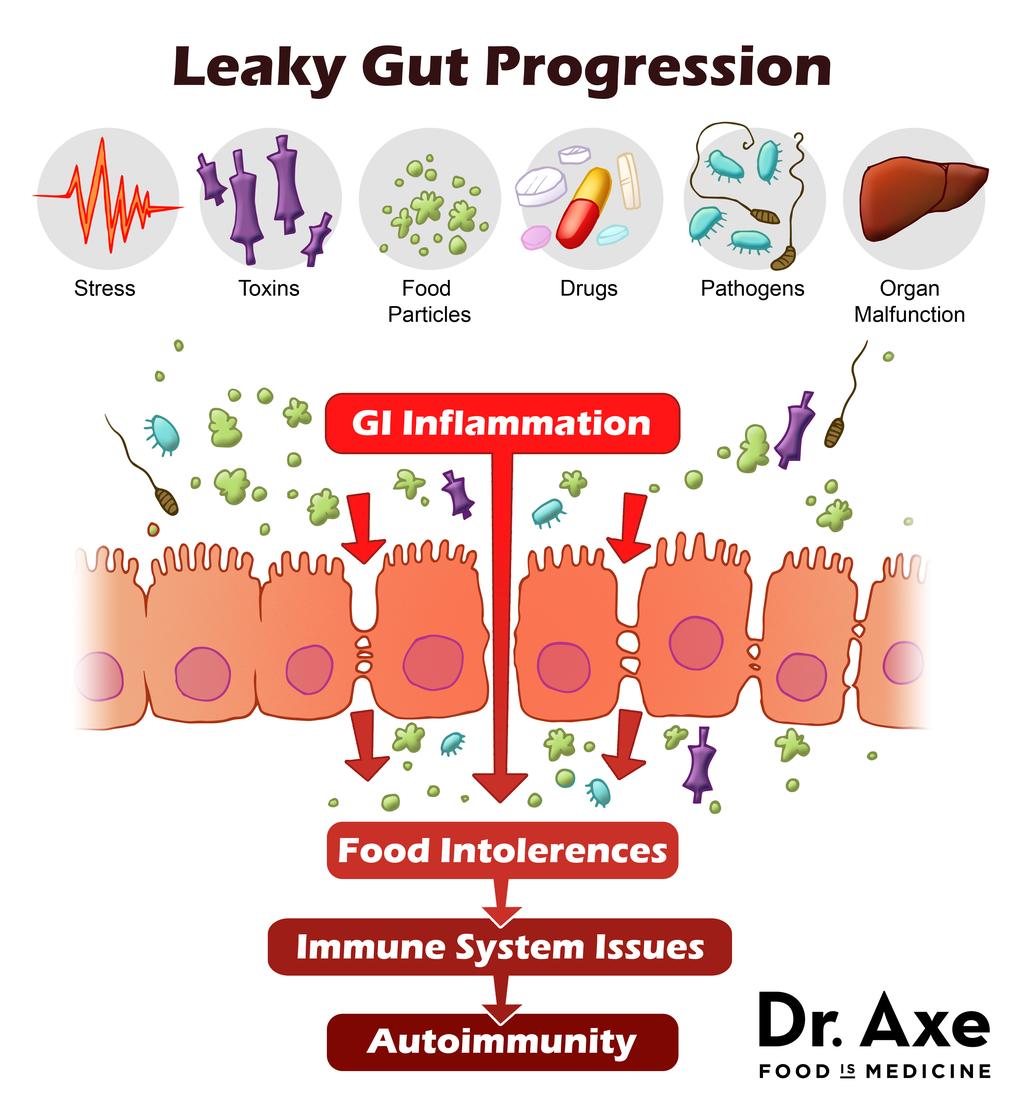 Lekkende darm = Leaky gut L i e s b e t h H a