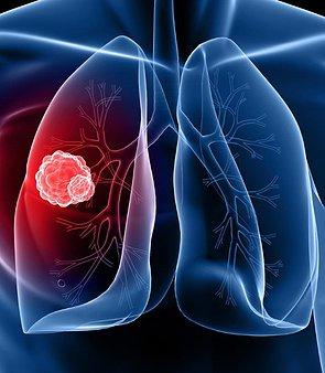 Questions 1. De rol van moleculaire diagnostiek bij de keuze van precisie therapie bij NSCLC. 2.