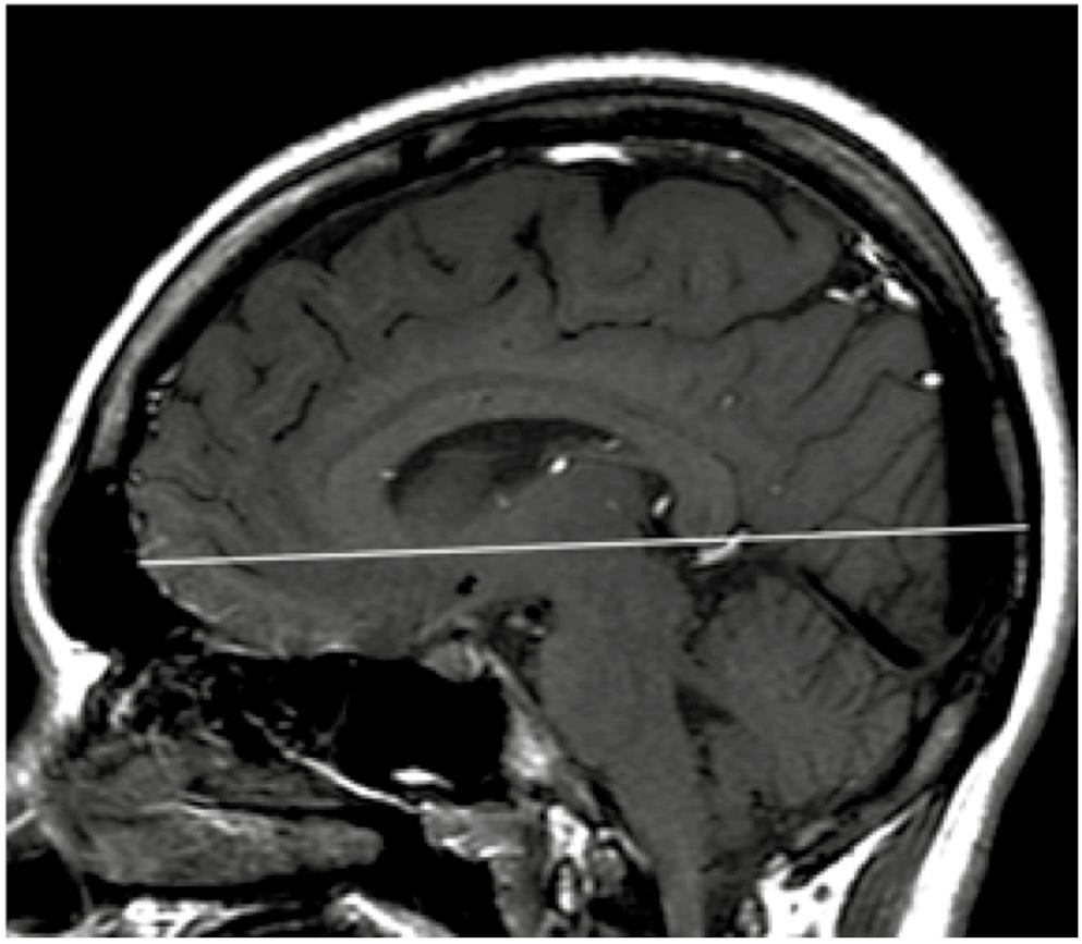 Standaard protocol MRI-hersenen (voor de uitgangssituatie en voor routinematige jaarlijkse scans bij alle patiënten): Veldsterkte scanner >1,0 T, plakdikte <5 mm zonder tussenruimte en met gehele