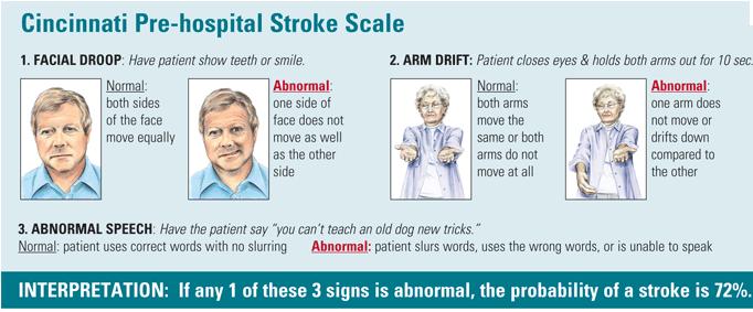 Triage FAST Cincinnati Prehospital Stroke Scale (CPSS) Los