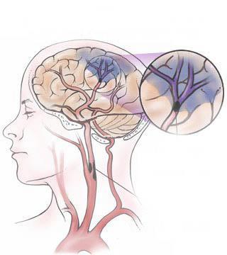 Introductie - CVA Aandoening van de bloedvaten van de hersenen. Paraplu term: ± 85% infarct, ± 15% bloeding. Is geen ongeluk!