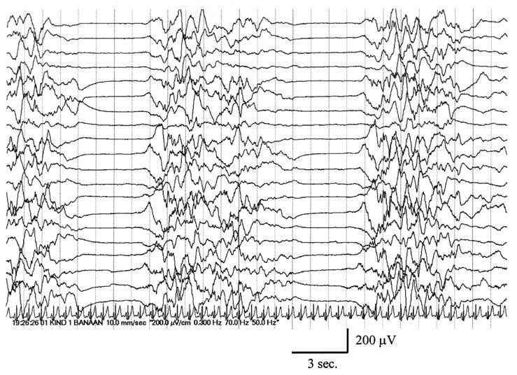 Figuur 1. Beeld van burst-suppressie EEG bij de behandeling van refractaire epilepsie met penthotal. mortaliteit) met SEP met een specificiteit van 100% gedetecteerd konden worden.
