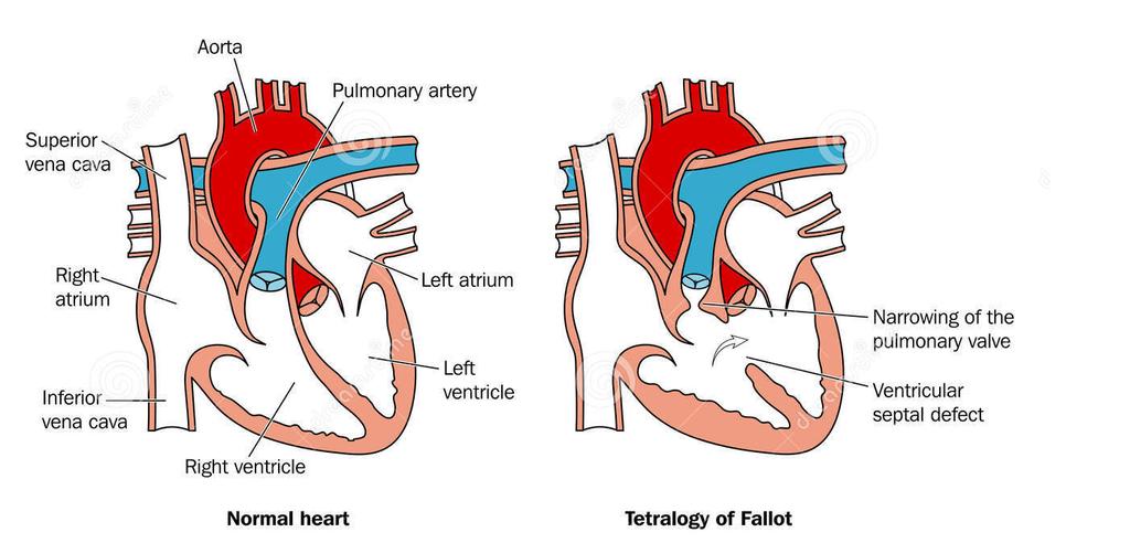 Een andere congenitale afwijking die u moet kennen is de tetralogie van Fallot: Deze aandoening kenmerkt zich door (1) een VSD, (2) een hypertrofisch RV, (3) een overrijdende aorta en (4) een
