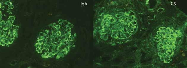 NEDERLANDS TIJDSCHRIFT VOOR HEMATOLOGIE Figuur 2. Immuunfluorescentie: IgA en C3. normaliseerde, met leukocyten van, x 10 9 /l en lymfocyten van 1,8 x 10 9 /l, zonder Gumprechtse schollen.