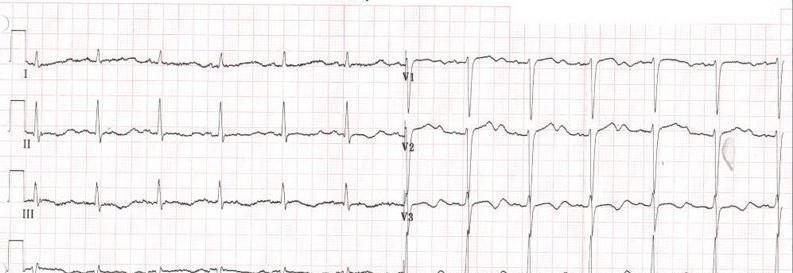 Hypokaliemie ST depressie negatieve T