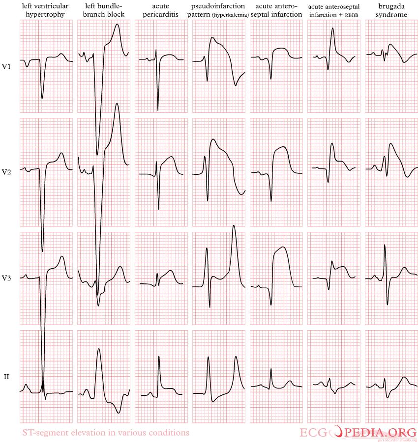 ST-elevatie: niet normaal 1: LVH 2: LBTB 3: pericarditis 4: hyperkaliemie 5: