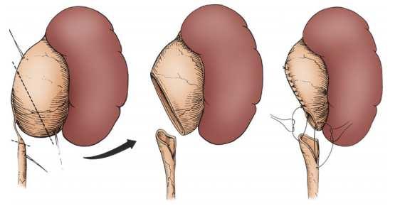 Wat is een UPJ stenose Bij een UPJ stenose (= vernauwing) is de uitgang van het nierbekken naar de urineleider vernauwd, maar niet helemaal dicht.