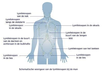HODGKIN LYMFOMA Kwaadaardige aandoening van bepaalde wi0e bloedcellen, lymfocyten, met aantas8ng van de lymfeklieren, Lymfeklieren verspreid over het