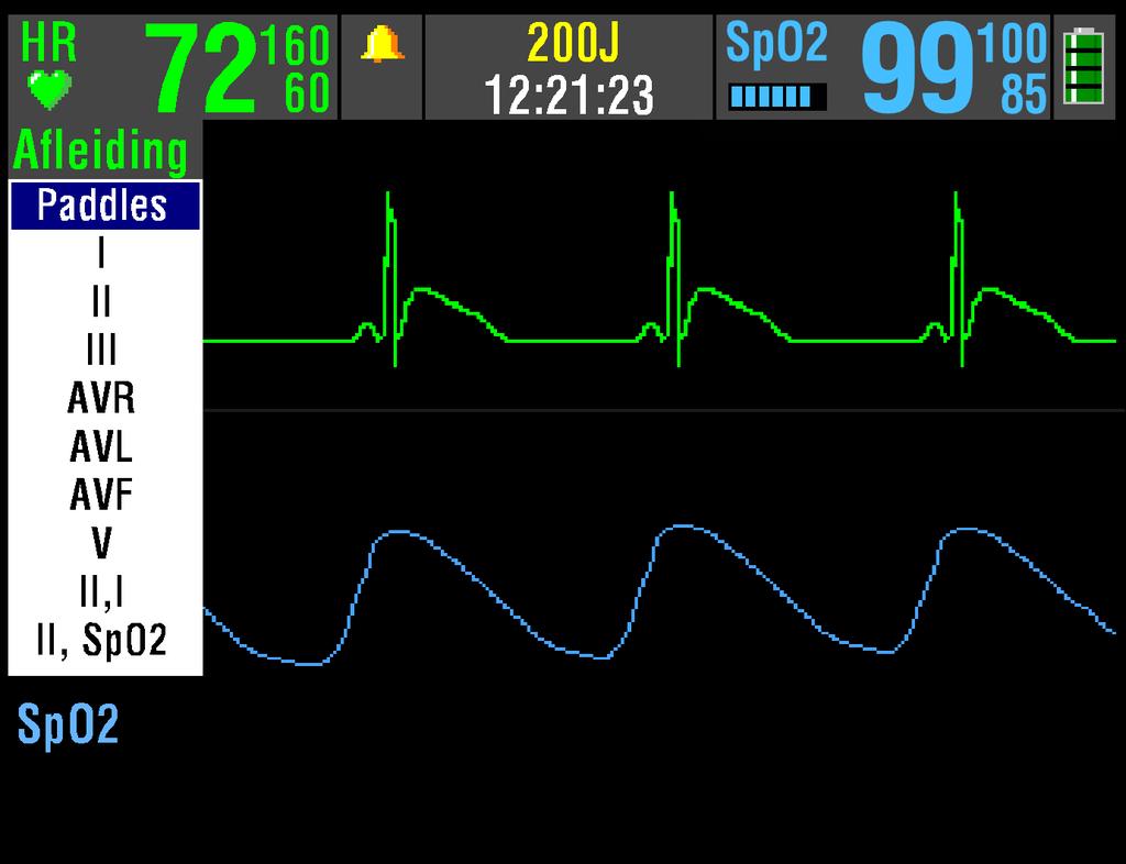 Bewaking ECG-BEWAKING In de volgende paragrafen worden de volgende onderwerpen beschreven: Waarschuwing bij ECG-bewaking ECG-afleiding en -maat selecteren Het systole-toonvolume instellen