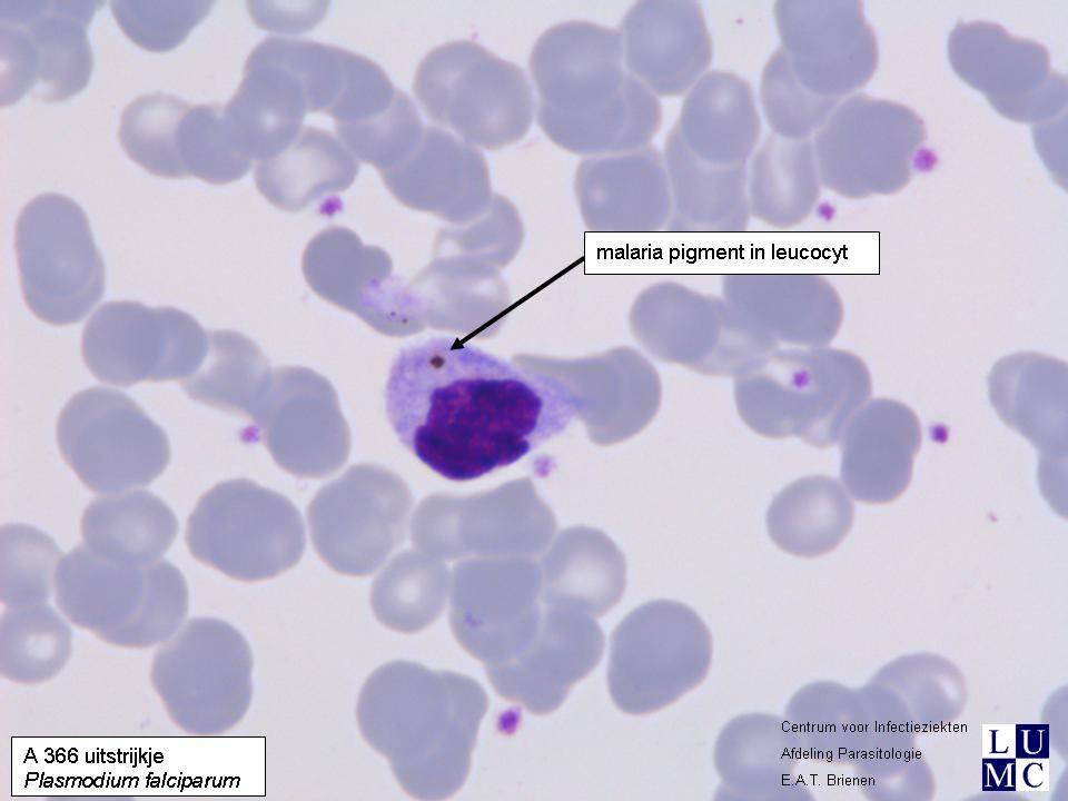 Verdiepingsvraag A-366 Na een verblijf van ruim 30 jaar in endemisch gebied, zonder profylaxe, met een verleden van malaria-episodes, wordt nu een lage P.