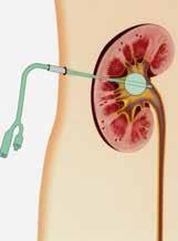 Urologie Uitwendige nierkatheter / nefrostomiekatheter polikliniek urologie = route 12 poliklinisch Inleiding In overleg met uw arts is besloten bij u een nefrostomiekatheter in te brengen.