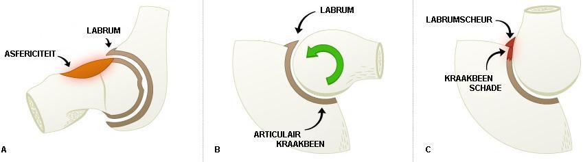 LITERATUURSTUDIE Figuur 3: (A) Cam-type femoroacetabulair impinement (B-C) Mechanisme van beschadiging. Opgehaald en vertaald op 22 maart 2011, van www.kingorthopedics.com/hip-impingement.