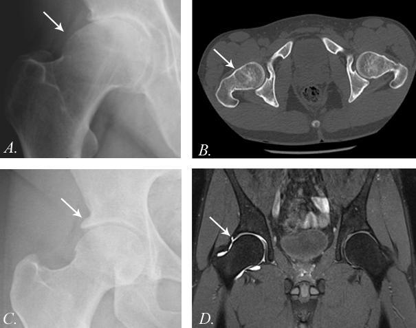 LITERATUURSTUDIE Figuur 4: (A) Cam-laesie op antero-posterieure pelvische opname. (B) Cam-laesie op CT. (C) Pincer-laesie op anteroposterieure pelvische opname (D) Cam-laesie op MRI.