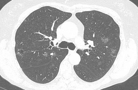 U heeft een voorloper van kanker 1: wigexcisie middenkwab rechts: minimaal invasief (non-mucineus) adenocarcinoom, maximale diameter 10 mm (invasieve deel 4mm).