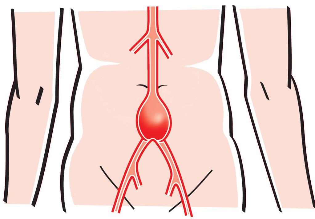 Wat is een aneurysma van de buikaorta? U heeft een aneurysma (verwijding) van de buikaorta. Dat betekent dat de aorta in uw buik wijder is dan normaal.