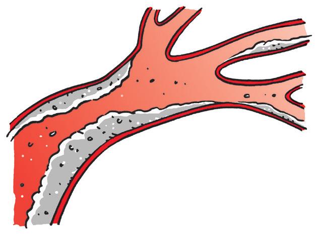 Hoe ontstaat een aneurysma van de buikaorta? Een aneurysma van de buikaorta kan ontstaan door chronische ontstekingen in de vaatwand van de slagader.