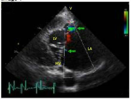 RA: rechter atrium, RV: rechter ventrikel, LV: linker ventrikel, AOV: klep van de aorta.
