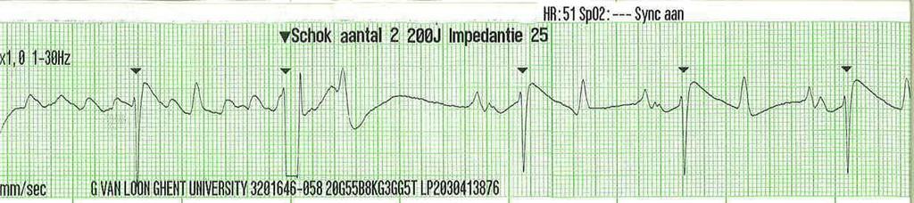 Figuur 3: ECG tijdens de TVEC en het bekomen normaal sinus ritme.