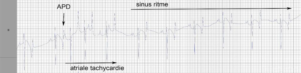 Figuur 6: Elektrocardiogram acht weken na tweede TVEC. APD: atriale extrasystolen Verder onderzoek met tissue Doppler imaging wees op herstel van de atriale functie.