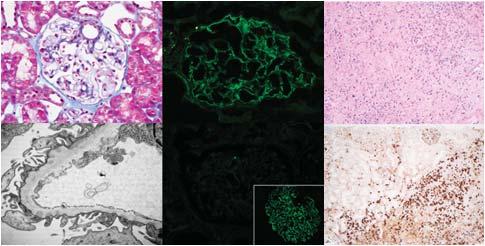 IgG4-gerelateerde glmerulnefritis GN geasscieerd met IgG4-gerelateerde ziekte membraneuze GN meest frekwent 7-10% andere GN HS purpura IgA nefritis endcapillaire prliferatieve GN membranprliferatieve