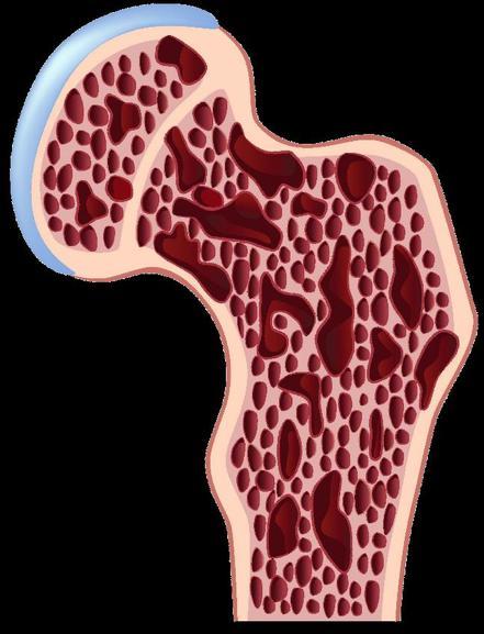 Effect of Ageing and Osteoporosis on the Proximal Femur FF0011