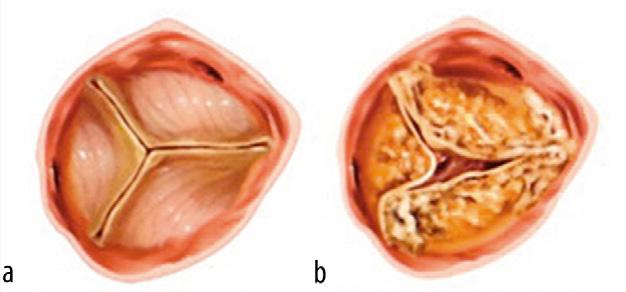 normale aortaklep verkalkte aortaklep Klachten Een geringe hartklepstenose geeft meestal weinig klachten.