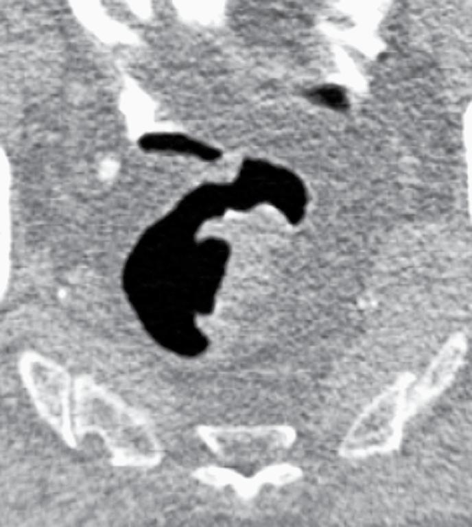 colon. 8 Bij CT-colografie is dit niet noodzakelijk: er vindt namelijk geen visuele inspectie in de darm plaats. Een goed contrast tussen darminhoud en darmwand volstaat.