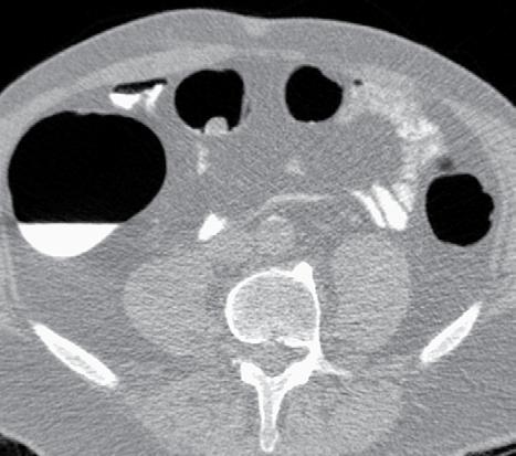 dunnedarmlis poliep colon transversum a colon ascendens wervellichaam colon descendens b FIGUUR 2 (a) Tweedimensionaal beeld van CT-colografie met poliep van 15 mm groot in het colon ascendens; (b)