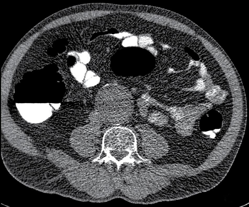 aneurysma aortae FIGUUR 3 CT-colografie van een patiënt met een rectumcarcinoom.