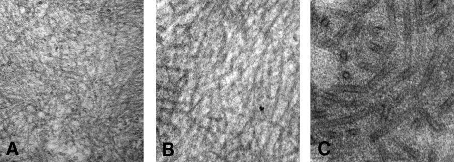 EM-onderzoek bij amorfe deposities Amyloidose Niet-vertakkende fibrillen 8-12 nm Fibrillaire