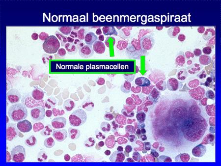 MGUS. EVALUATIE. PBO. Serum calcium en creatinine. Serum elektroforese en immunofixatie. Urine elektroforese en immunofixatie.