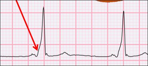 V6: R >26 mm PR < 0,12 sec en