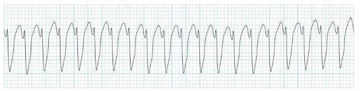 smal QRS complex (< 0,12 sec) - P-top in of achter het QRS complex AV-junctioneel ritme