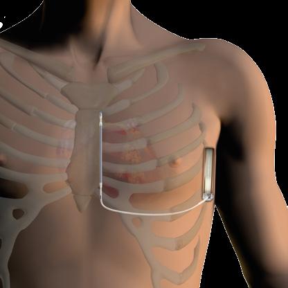 DEFIBRILLATIE WANNEER u HET NODIG HEBT NAUWKEURIGE DEFIBRILLATIETHERAPIE Zoals uw arts draden op uw borst plaatst om uw hart te bewaken tijdens het maken van een elektrocardiogram of ECG, bewaakt een