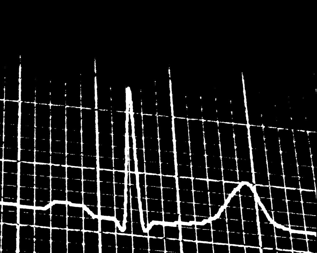 transplantatie voor transplantatie UZ Leuven UZ