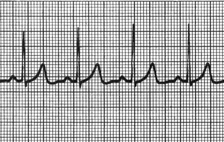 defibrillators (AED's): ontworpen voor de behandeling van VF en VT