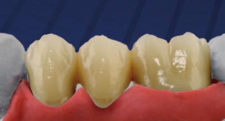 ht-dentine A3 en snijmassa S3